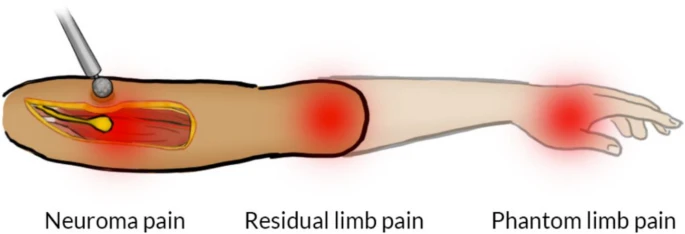 post-amputation pain