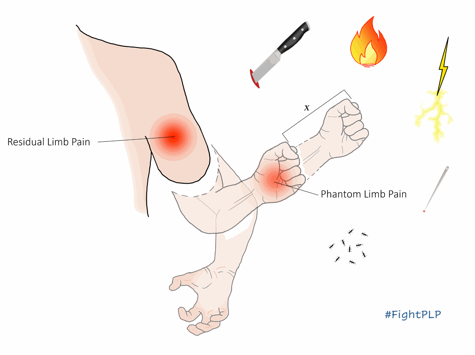 How does PLP feel? phantom limb pain vs residual limb pain